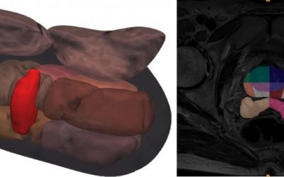 Fighting prostate cancer with over 1.5 million MRI images