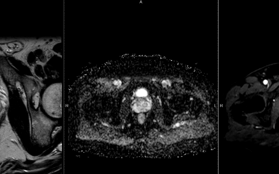 UC6: Artificial Intelligence-Powered Prediction of Prostate Cancer Treatment Response After Radiation Therapy